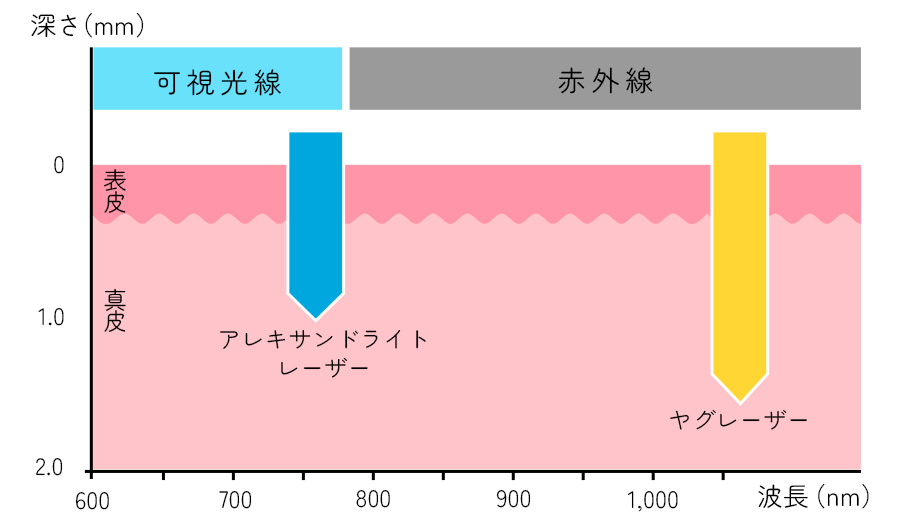 愛知県知立市・刈谷市・安城市の医療脱毛でジェントルマックスプロを導入している知立南クリニックのレーザーの特徴