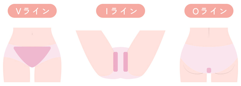 VIO脱毛の施術範囲