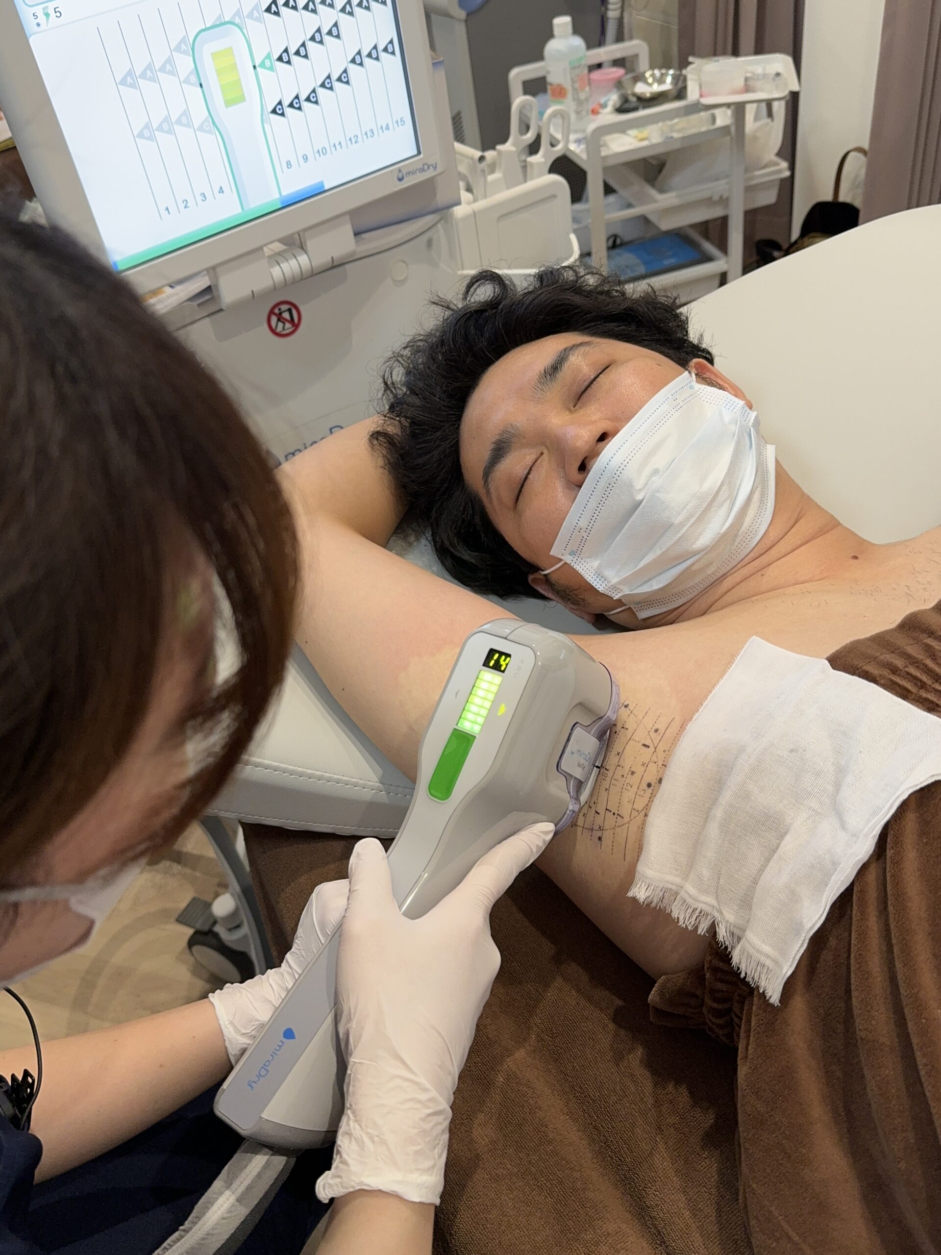 〜多汗症治療〜院長のミラドライその後…