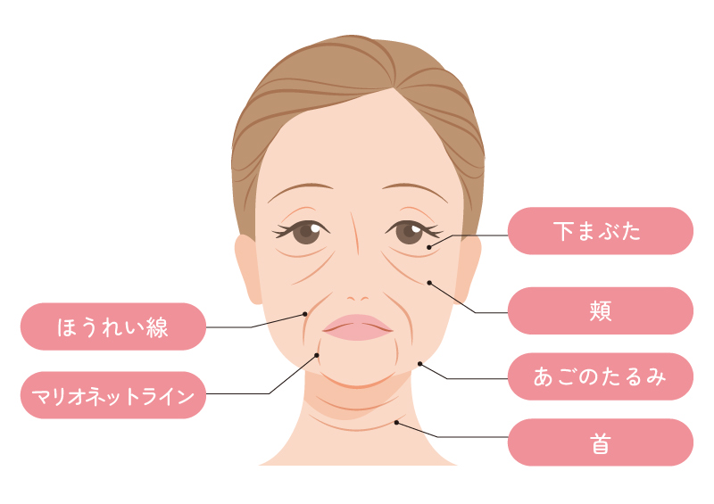 たるみの種類のイラスト